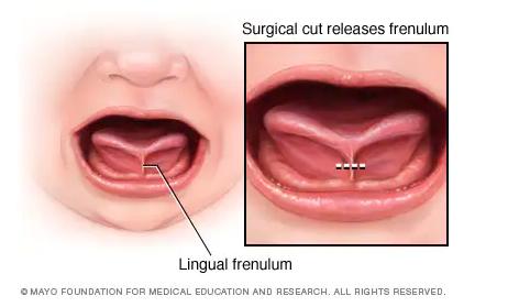看小孩舌头知病情和解决方案,看孩子舌头可以判断出哪些病