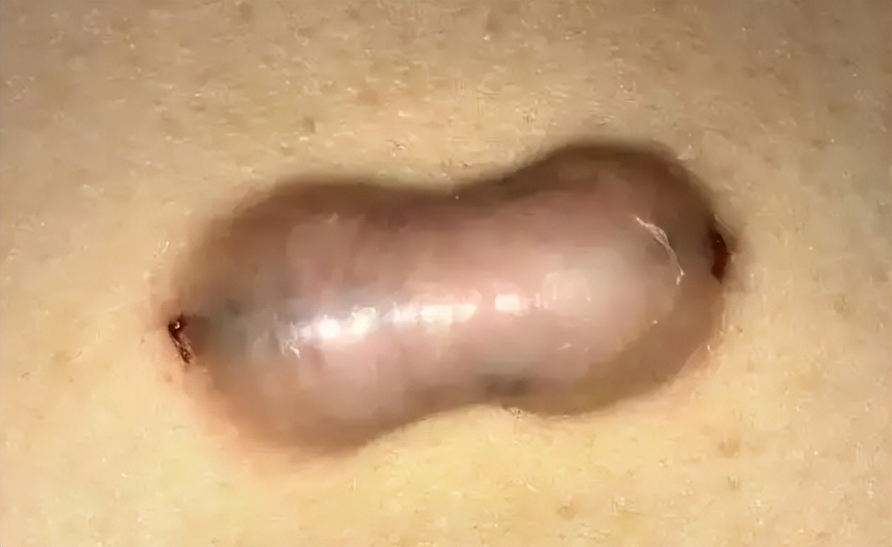 疤痕疙瘩破了出脓怎么治,疤痕疙瘩破溃怎么治疗