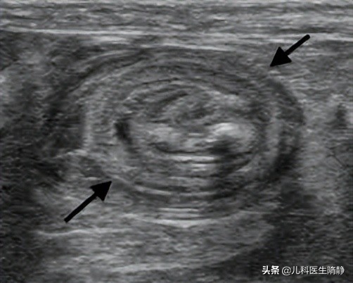 儿童肠套叠如何治疗,肠套叠治疗一般多少钱