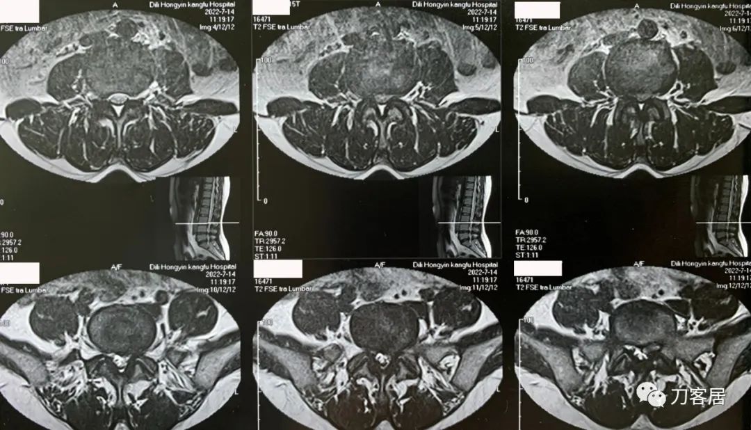 50岁坐一下站起腿发麻,30岁女性左腿麻木是什么病的前兆