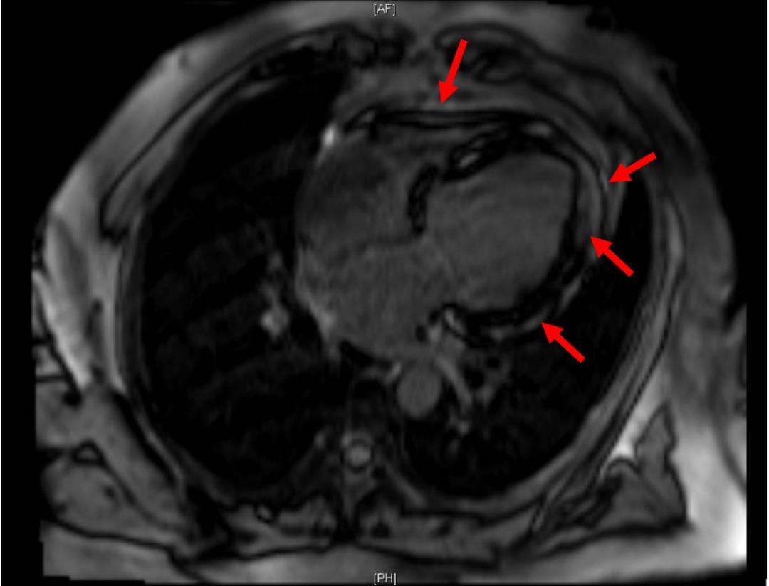心电图qrs时限超宽是什么引起的,心电图qrs波呈m型见于什么疾病