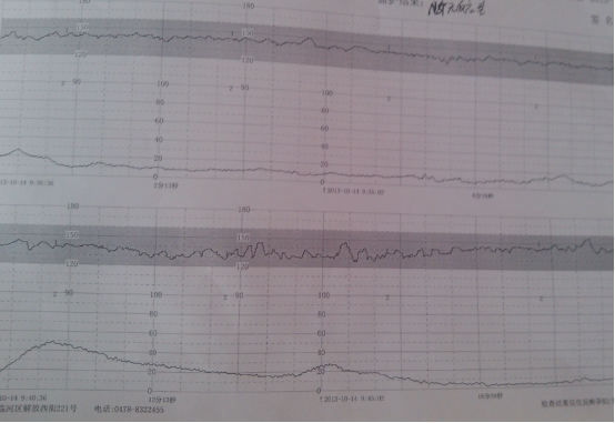 补充叶酸和维生素B6，可有效预防脑梗死，科学服用注意4点