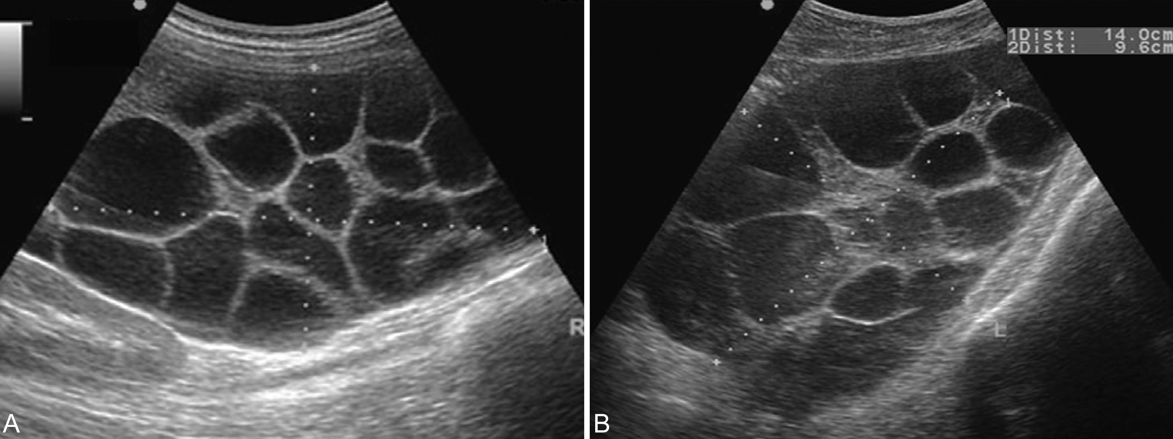 超声全身检查,超声诊断恶性葡萄胎