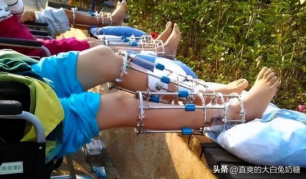 李亚诺断骨增高怎样了,断骨增高手术的李亚诺现状