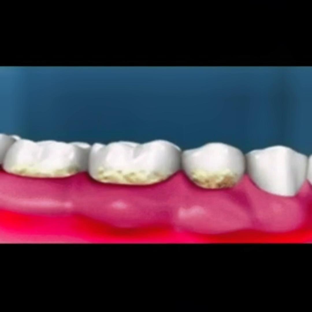 滂臭预警！牙缝抠出来的软垢到底是什么？#usmile笑容加