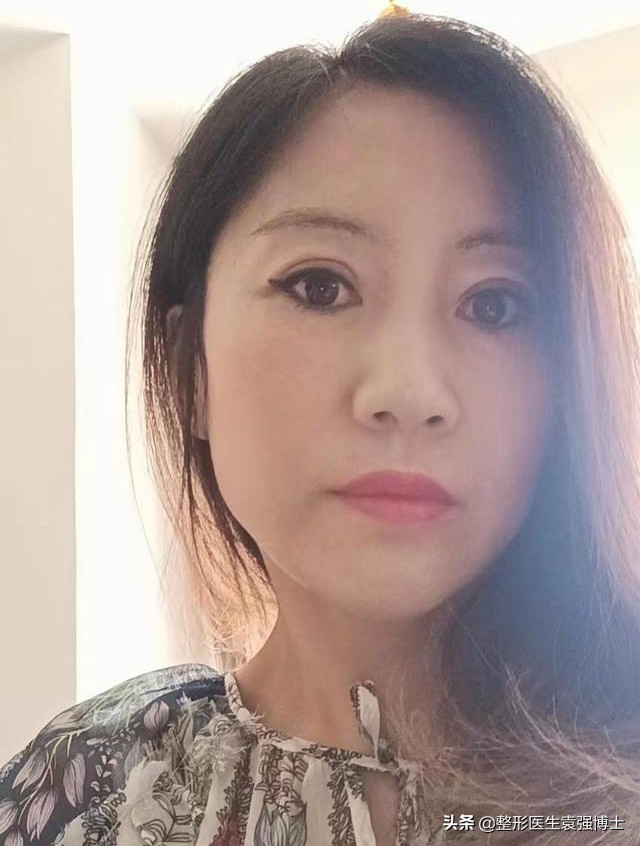 45岁做拉皮多少钱,北京做大拉皮前后对比照片图文