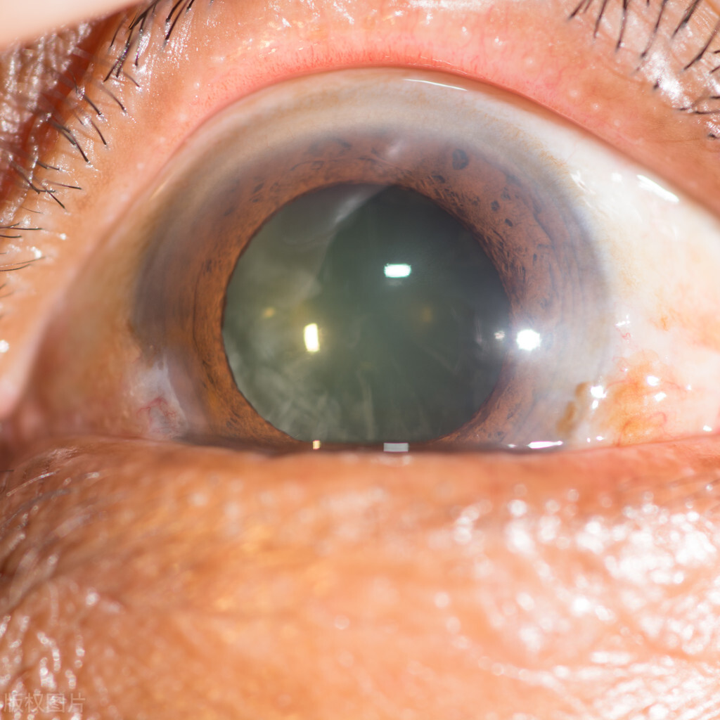 白内障的十种表现,白内障有哪些表现