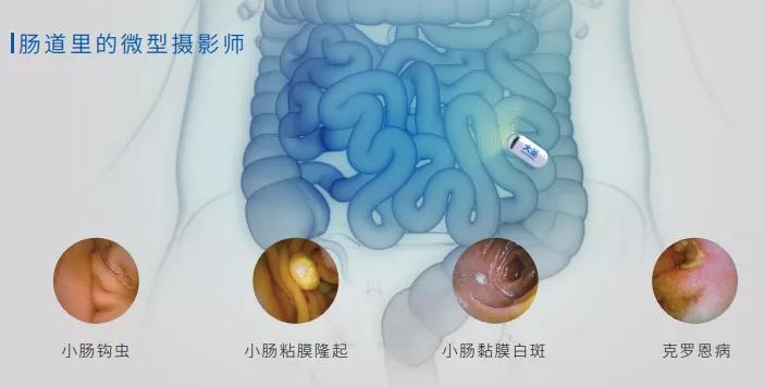 男方有克罗恩病影响生育吗,要不要跟得克罗恩病的人结婚