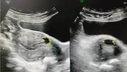 年轻妈妈剖宫产后子宫憩室，宫腹腔镜联合手术修复更彻底