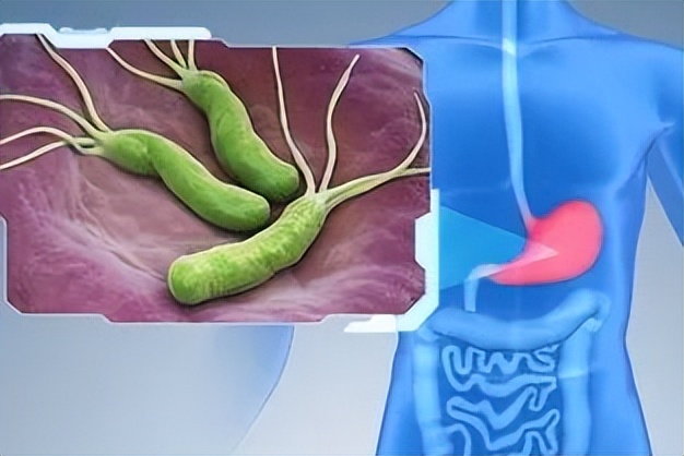 癌不传染但这4种癌要小心,癌症有没有可能传染后代