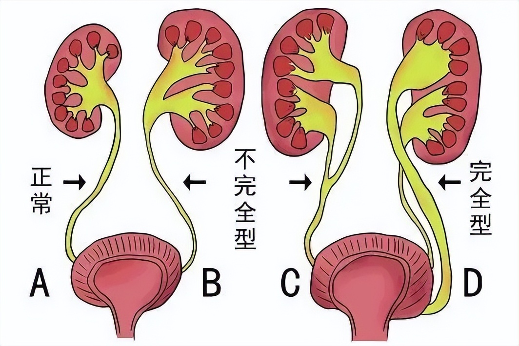 31岁女性“硬抗”多年，原是输尿管“跑偏”