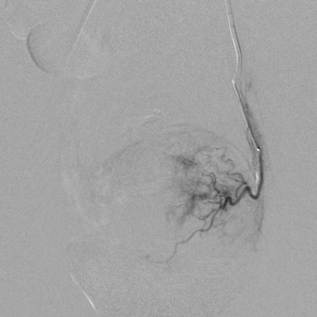 14岁女孩非经期出血,14岁女孩非月经期出血是怎么回事