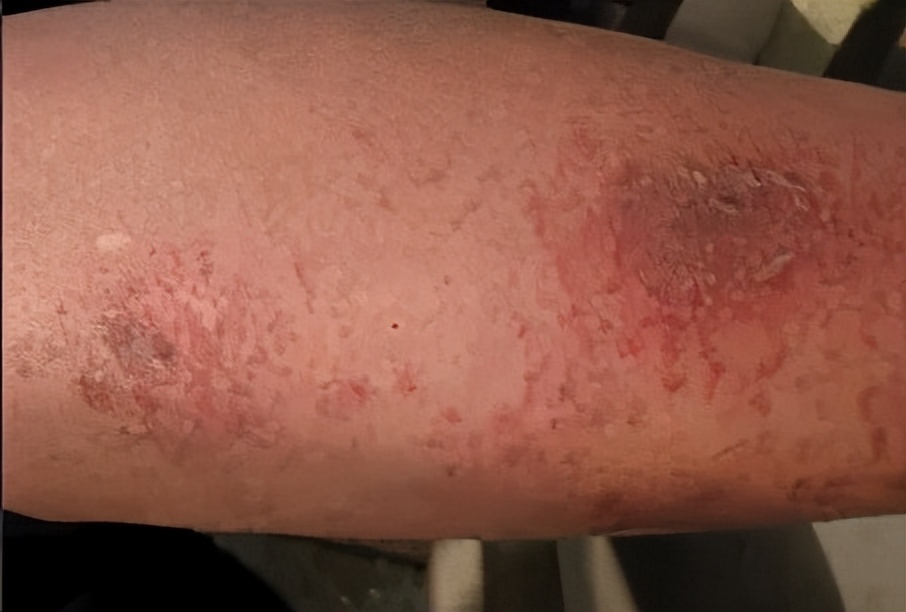 血虚风燥型荨麻疹吃肤痒颗粒行吗,顽固性荨麻疹遇热加重中药方子