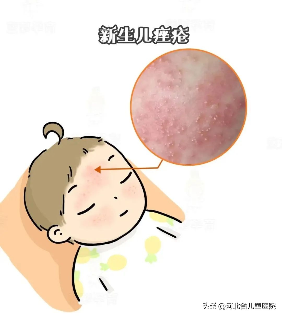 长青春痘了怎么快速消除,如何防止新生儿长青春痘