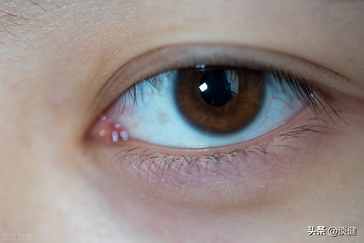 五种致盲性眼病应该要警惕,每天用眼过度需要滴什么眼药水吗