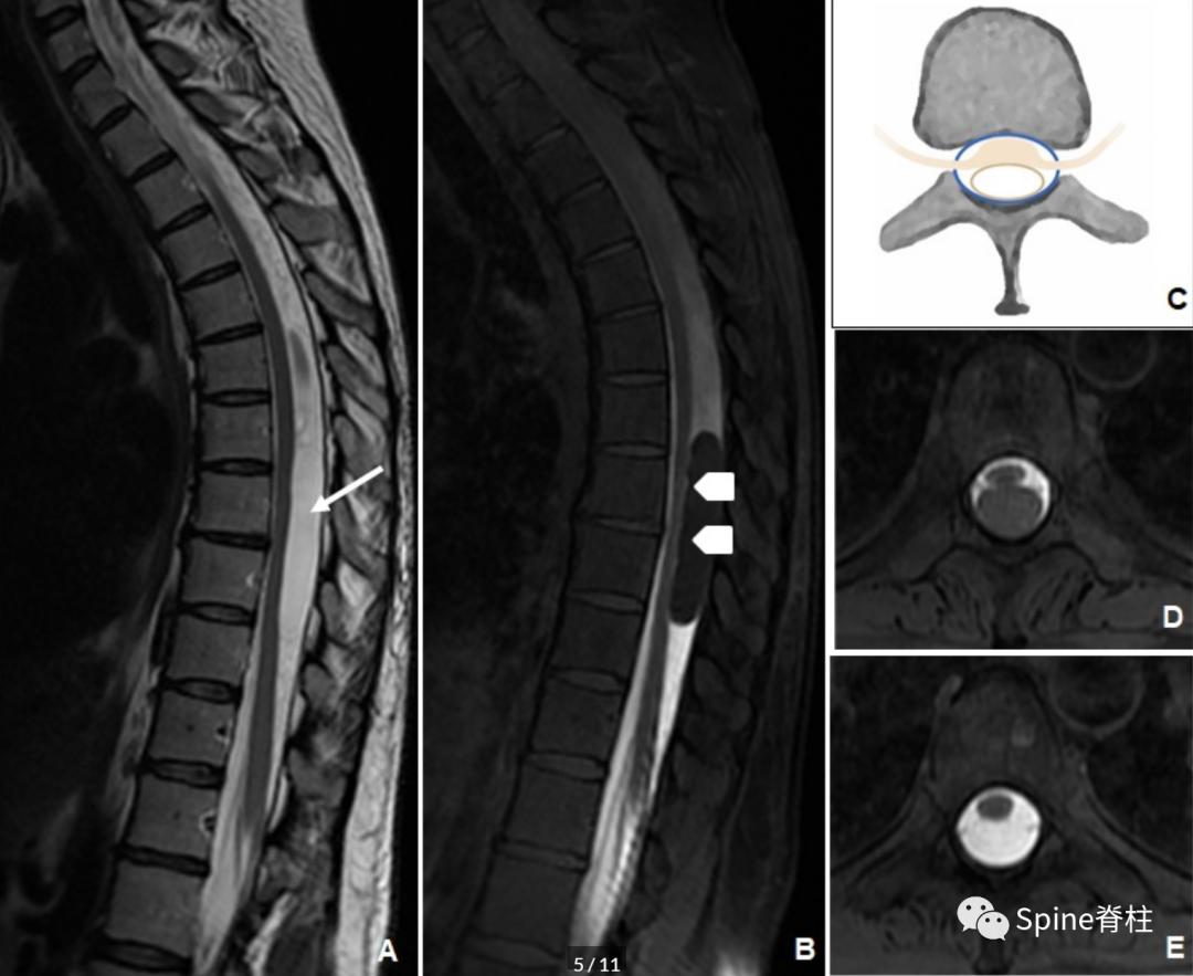 腰椎椎管有囊性结构,水平椎管内囊性占位