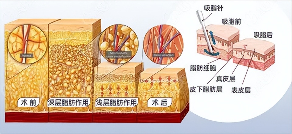 上海九院吸脂收费标准,九院韦敏面部吸脂