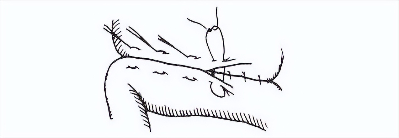 外科缝合技巧你熟练吗,外科缝合术的操作步骤