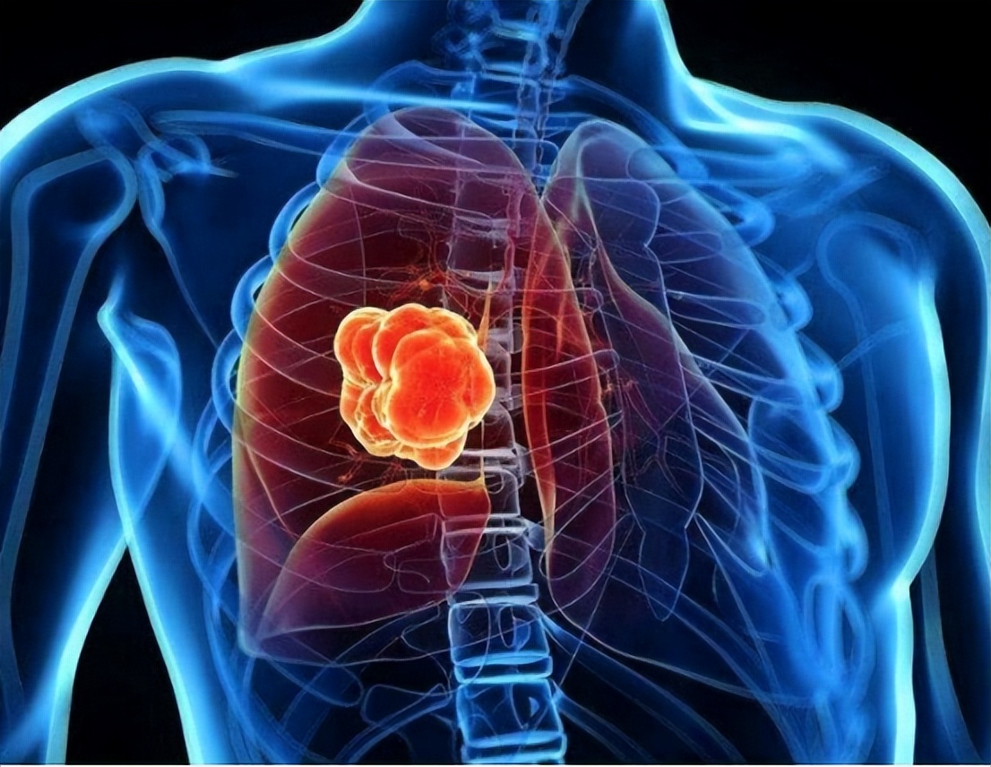 拔火罐吸出来的淤血，是体内的毒素？告诉你真相，看完涨知识