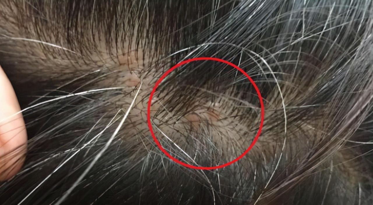 为什么头皮老是长脓包痘痘,为什么头皮长脓包还会出脓水