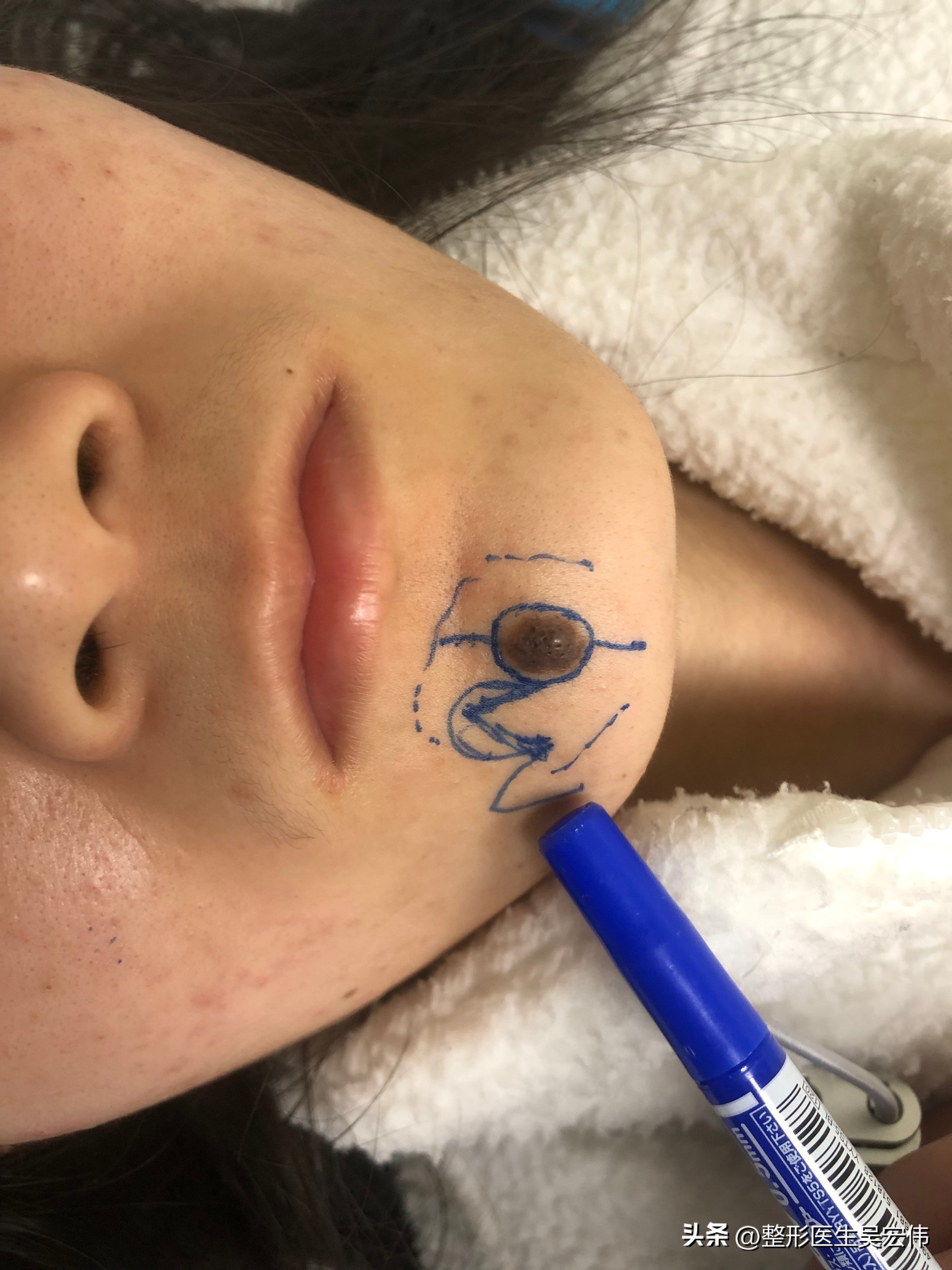 面部痣切除缝合不平整,面部痣可以去掉吗