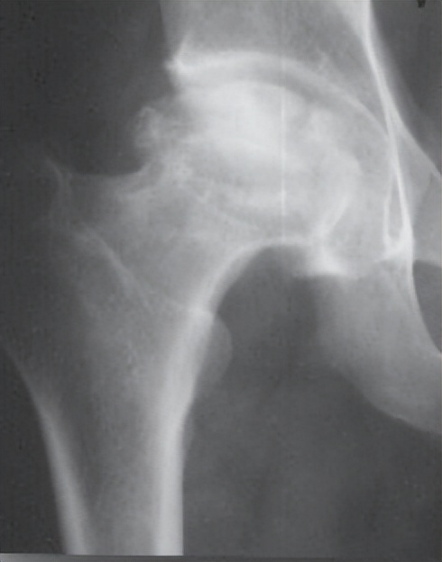 股骨头坏死保髋微创手术成功率,髋部骨头坏死微创手术康复训练