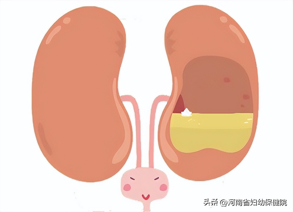 武汉婴儿肾积水去哪个医院看,胎儿肾积水尿道扩张