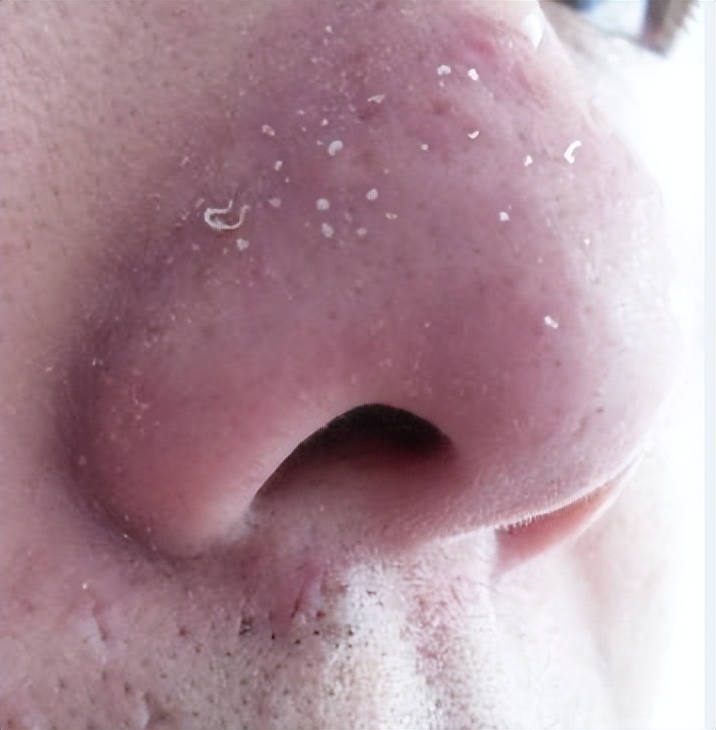 鼻子黑头挤出水一样的液体,鼻子挤黑头粉刺