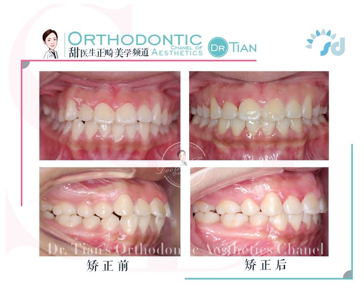 不拔牙矫正嘴凸下巴后缩案例,嘴瘪不拔牙矫正嘴会凸怎么办