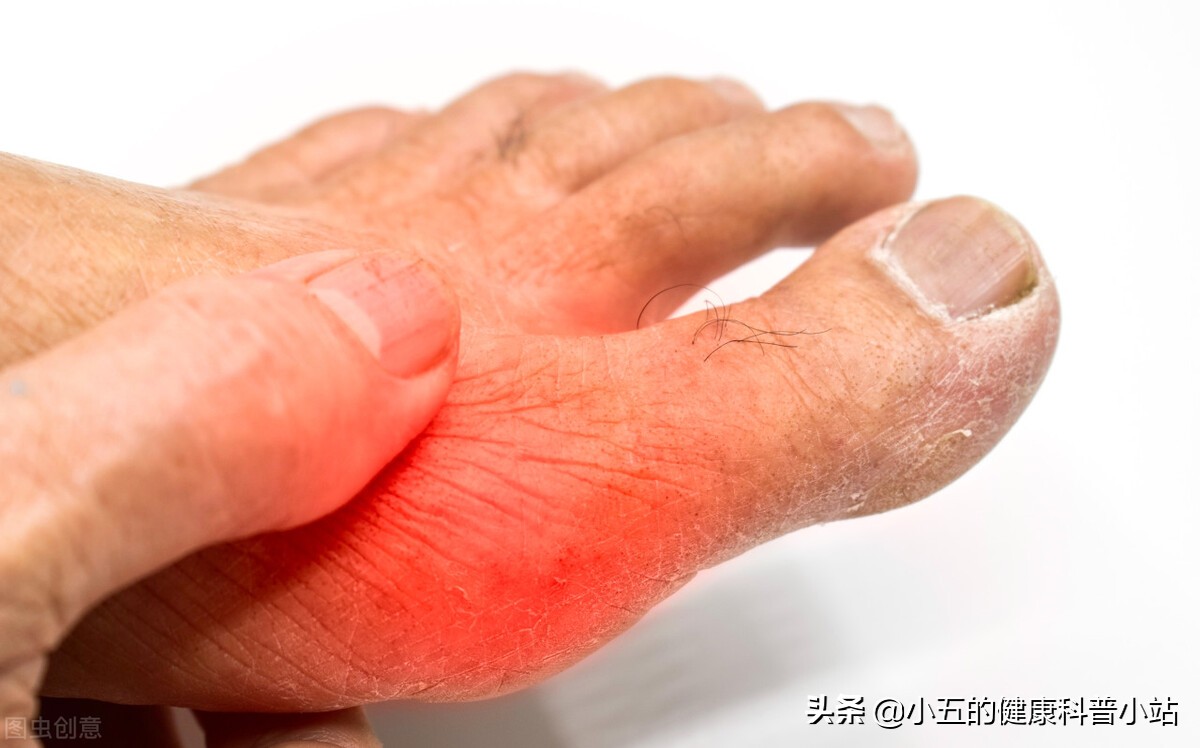 非布司他是防治痛风的常用药，可以长期服用，但需要注意这4点