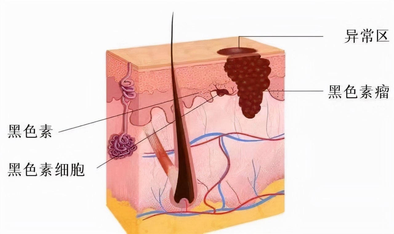 38岁脚底长瘤,脚脖子长疙瘩会有哪些恶性肿瘤