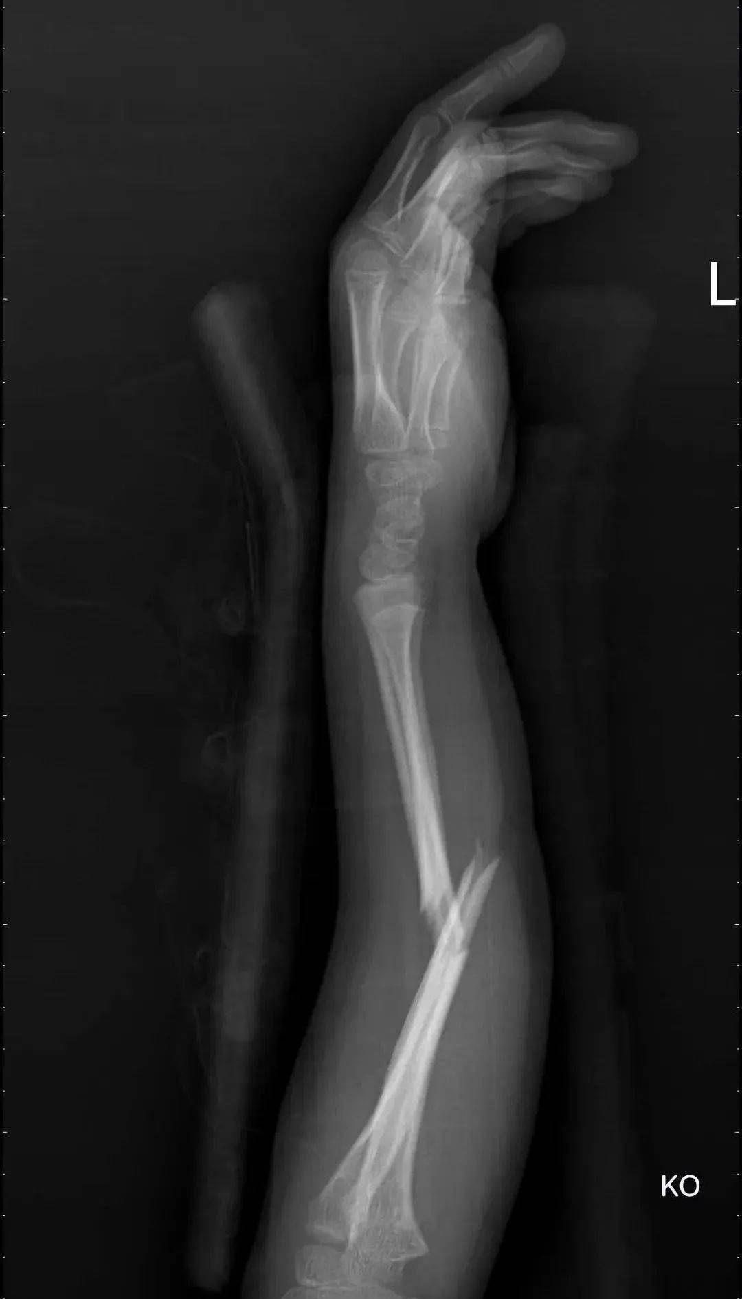 中医怎么处理小儿桡骨骨头骨折,治疗尺桡骨骨折的方法及步骤