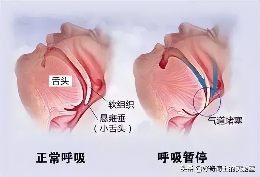 打呼不是病打起来要人命,打呼是一种病吗怎么治