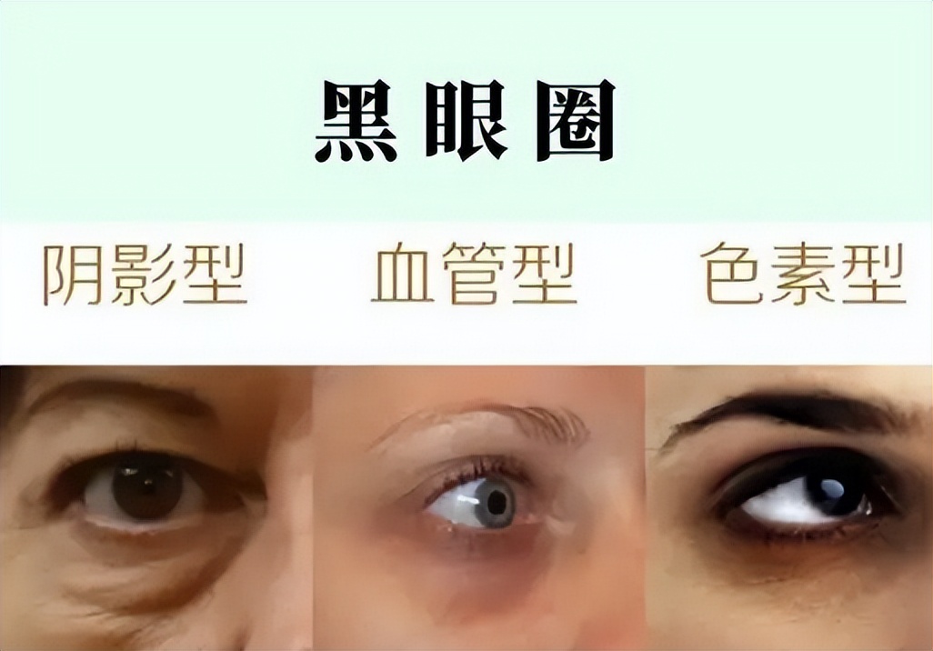 黑眼圈眼袋泪沟重怎么遮瑕,眼霜推荐去黑眼圈眼袋泪沟