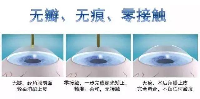 本想做近视手术，却发现眼底上破了个“洞”！需不需要治疗？