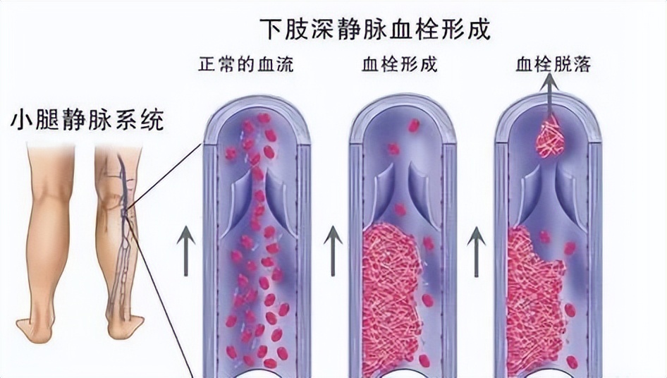 下肢静脉血栓患者能做康复训练吗,膝盖手术后下肢静脉血栓康复训练
