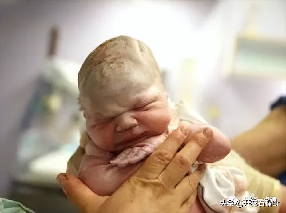 新生儿这5大状况你最担心哪个,新生儿有些表现不用治您知道吗