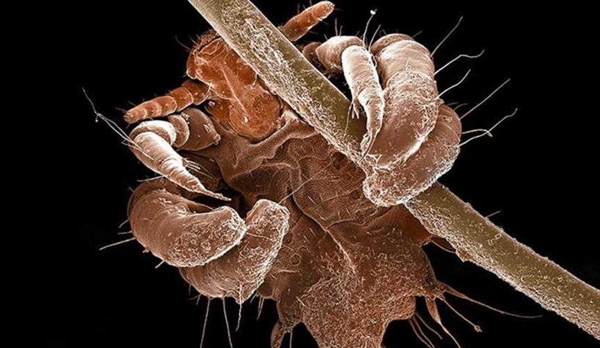 女子体内有蜱虫被医生拿镊子拔出,女子身上长虫医生拿镊子治疗