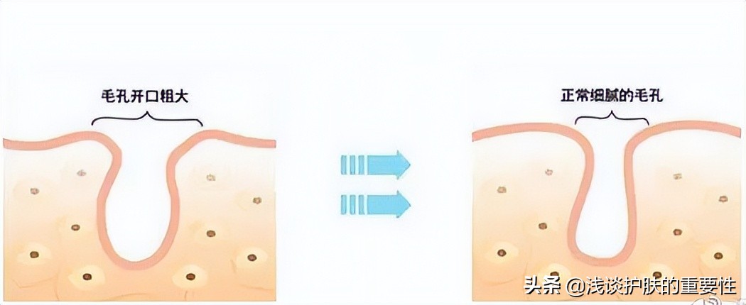 毛孔粗大爱出油适合什么护肤品,t区出油毛孔粗大用什么护肤品