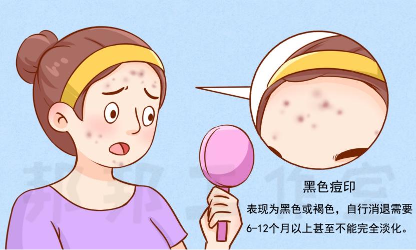 痘印全攻略——不同类型的治疗选择