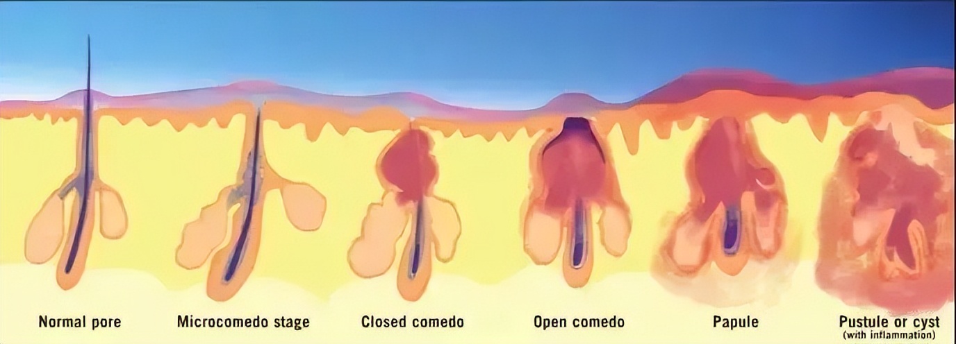 祛痘的十大误区你中招了吗,祛痘也有误区痘痘肌教你护理