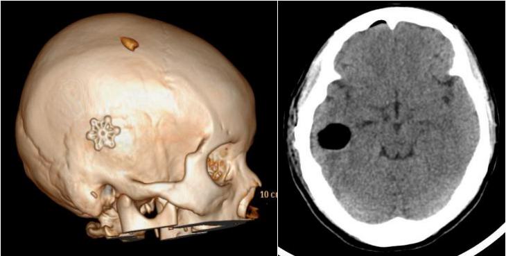 脑科手术难保秀发？医生从约1.3cm的骨孔实施手术