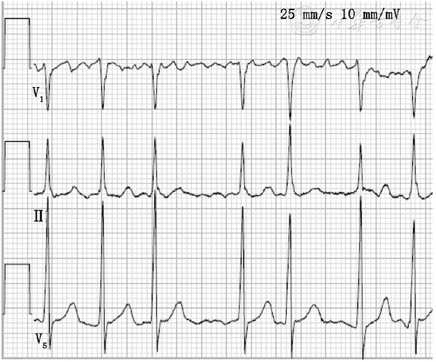 蹇冩埧棰ゅ姩鍩哄眰璇婄枟鎸囧崡2019ppt,蹇冩埧棰ゅ姩鍩哄眰璇婄枟鎸囧崡2019