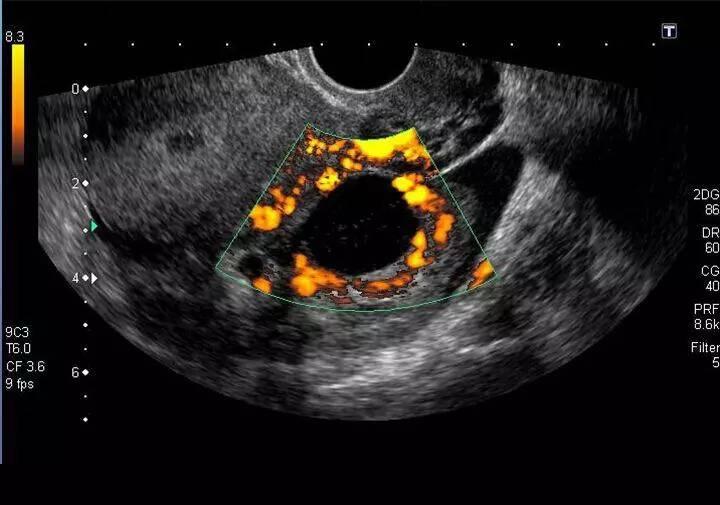 卵巢癌发出的警报有哪些,卵巢癌的早期信号会有哪些