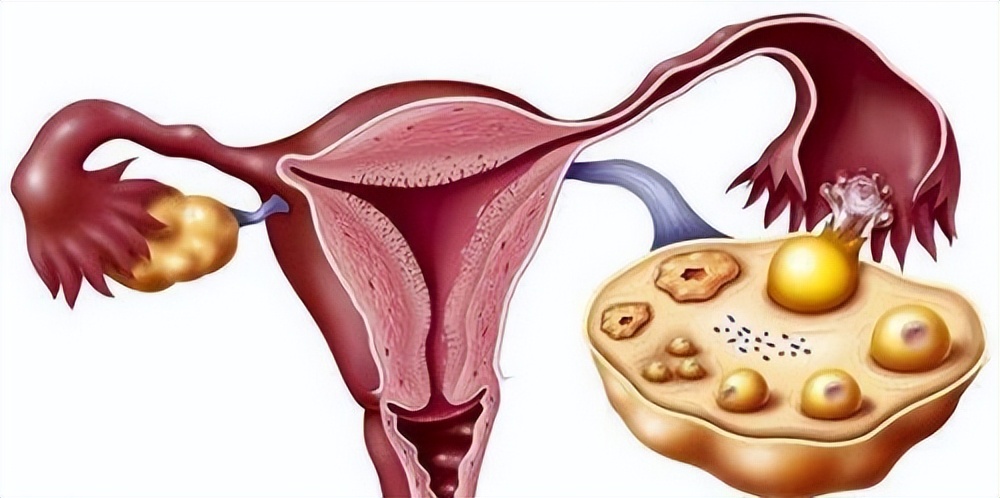 65岁子宫内膜癌早期10种症状,26岁女子子宫癌