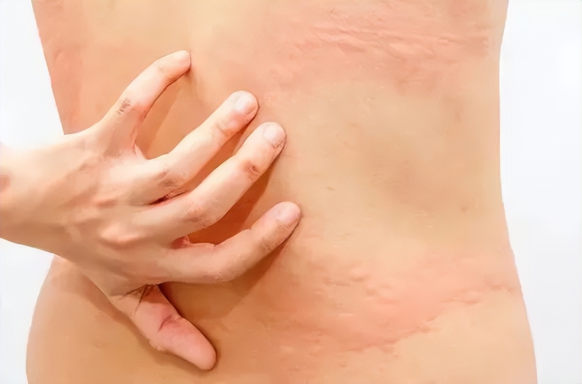 皮肤好痒啊,皮肤痒越挠越痒买什么药