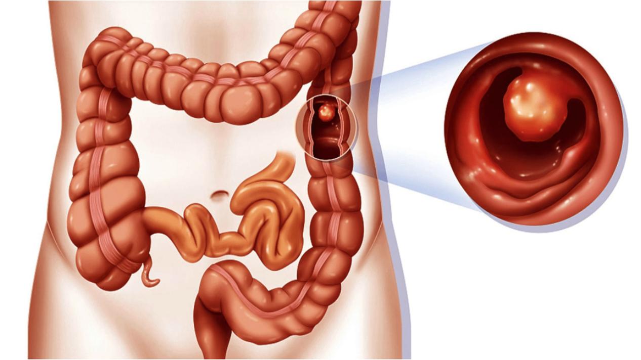 老年人摔了一跤筋摔伤了,老人腿骨摔骨折了吃啥补好