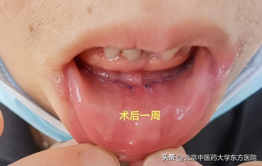 甲状腺手术不留疤痕的方法,甲状腺手术三年疤痕增生会疼吗