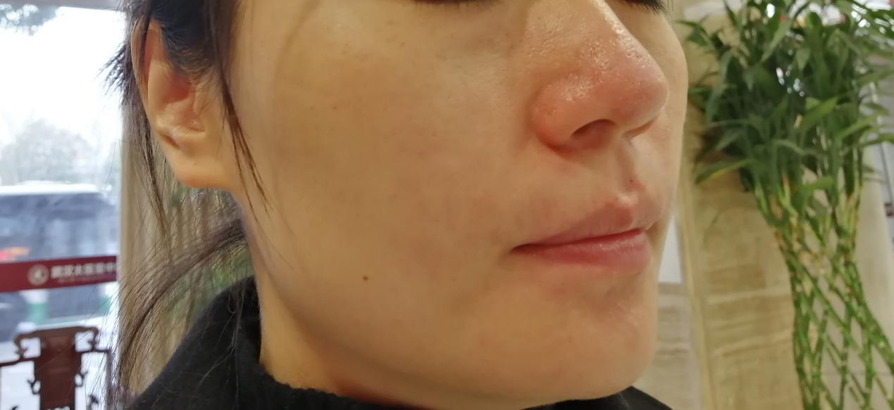 女人脸上反复长痘是什么原因,女人最容易长痘是什么原因