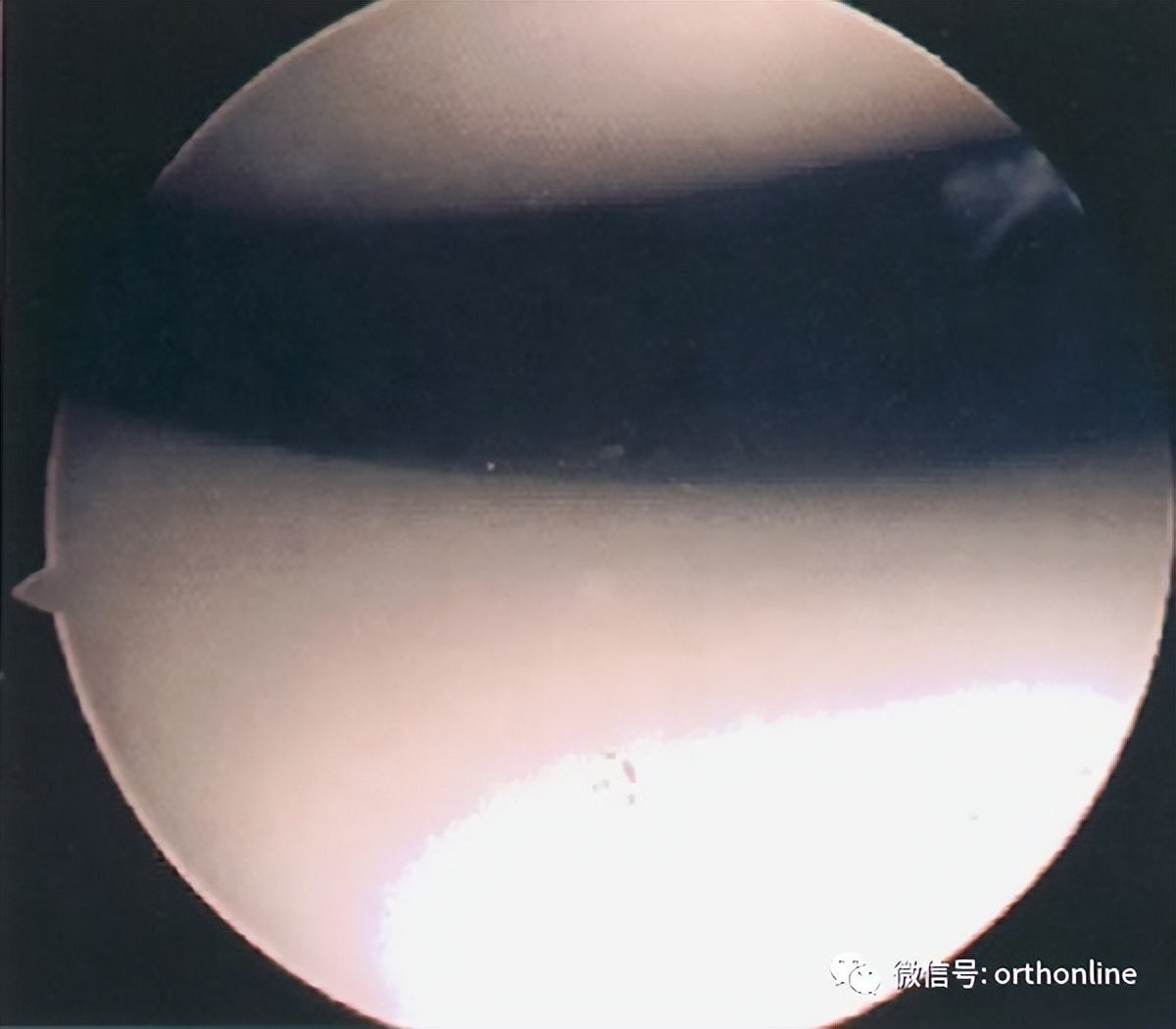 髌骨软化症的最佳疗法是什么,髌骨软化症治疗方法以及康复训练